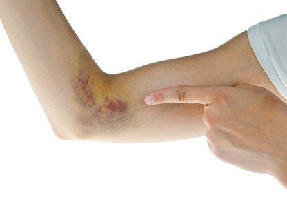 Bluterguss am Arm mit Heilpflanzen schnell abheilen